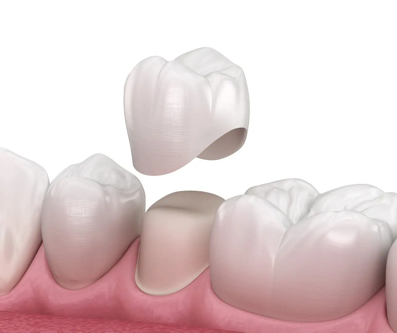Porcelain Crowns