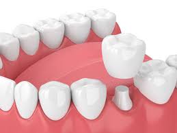 Zirconia Crowns
