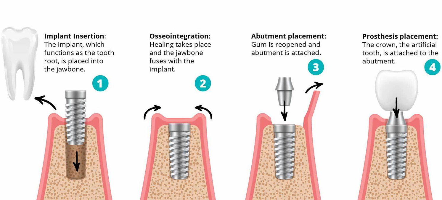 Implants Process