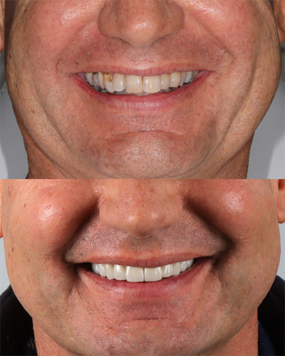 Veneers Smile Makeover 1