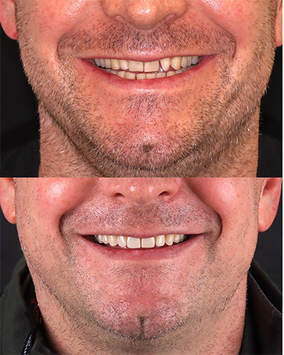 Veneers Smile Makeover 10