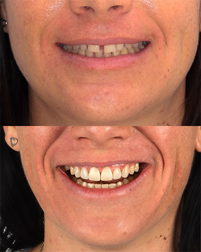 Veneers Smile Makeover 11