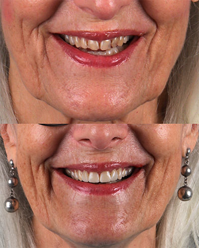 Veneers Smile Makeover 12