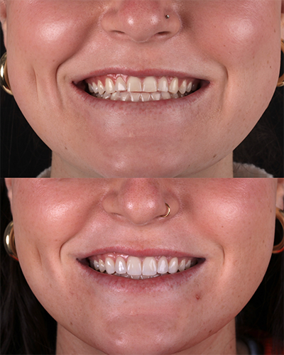 Veneers Smile Makeover 13