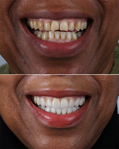 Veneers Smile Makeover 14