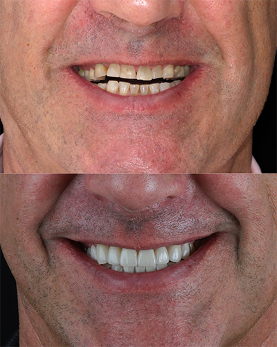 Veneers Smile Makeover 15