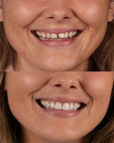 Veneers Smile Makeover 16