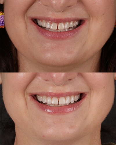 Veneers Smile Makeover 17