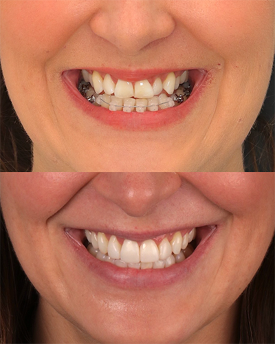 Veneers Smile Makeover 18