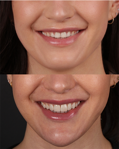 Veneers Smile Makeover 19