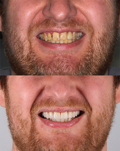 Veneers Smile Makeover 2