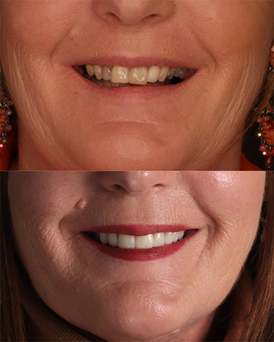 Veneers Smile Makeover 20