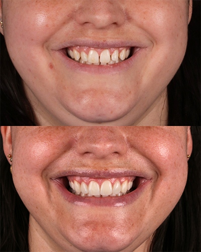 Veneers Smile Makeover 21