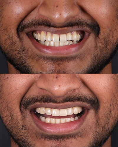 Veneers Smile Makeover 3