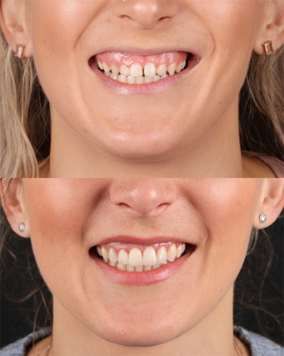 Veneers Smile Makeover 5