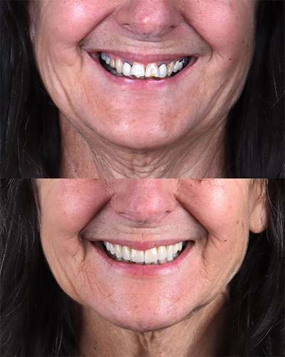 Veneers Smile Makeover 6