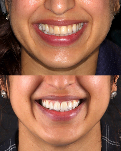 Veneers Smile Makeover 7