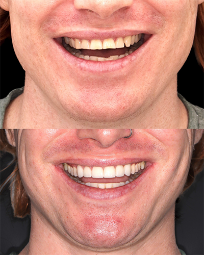 Veneers Smile Makeover 8