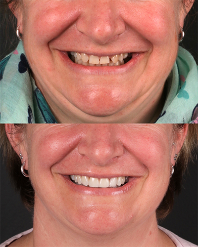 Veneers Smile Makeover 9